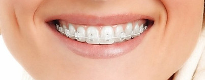 ventajas-desventajas-brackets-esteticos.