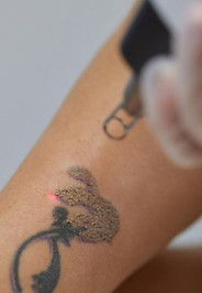 jovem-passando-por-procedimento-de-remoc