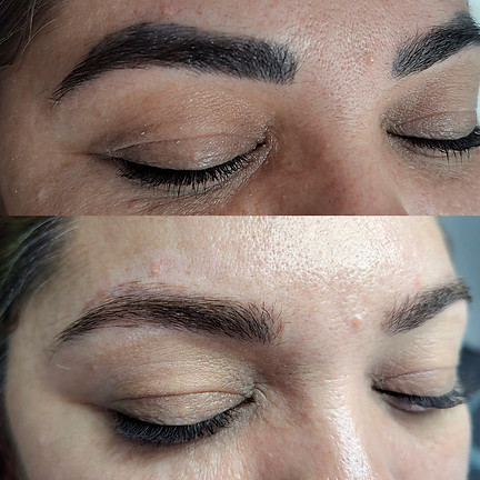 sobrancelha antes e depois da despigmentaçao a laser