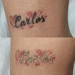 tatuagem antes e depois da remoção a laser