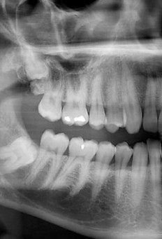 panoramic-xray.jpg