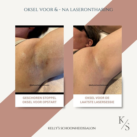 Oksel na laser