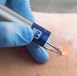 Laser apparaat voor bloedvaatjes verwijderen gezicht