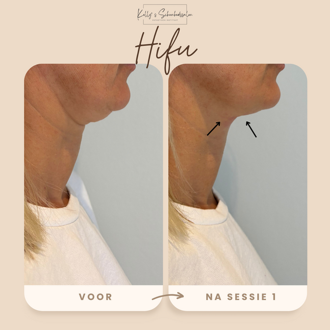 Voor en na HIFU behandeling kin, hals en wangen – lift