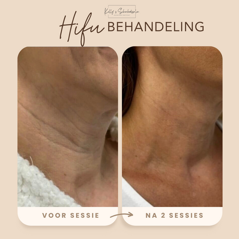 Hifu Behandeling Deinze - Nevele - Aalter - Gent - Voor en na foto van vrouw