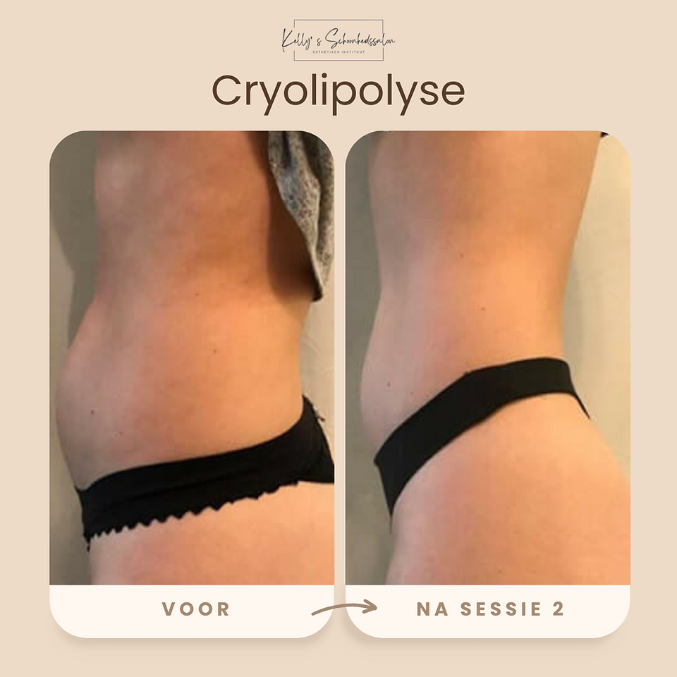 Cryolipolyse behandeling voor en na bij vrouw uit Gent