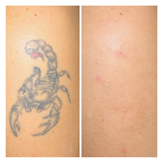 Tattoo laseren voor en na