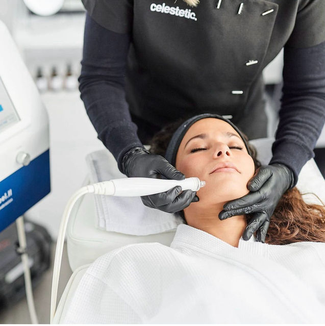 Hydrafacial Behandeling in Deinze tegen mee-eters, onzuiverheden en acné