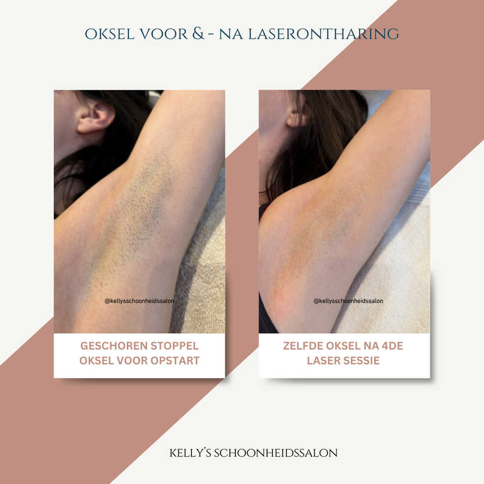 Laserontharing Oksel Kelly Schoonheidssalon Voor en NA