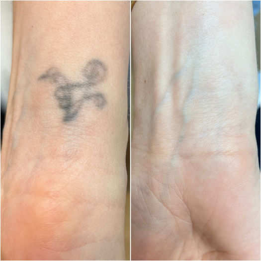 Tattoo weglaseren voor en na in Deinze en Gent