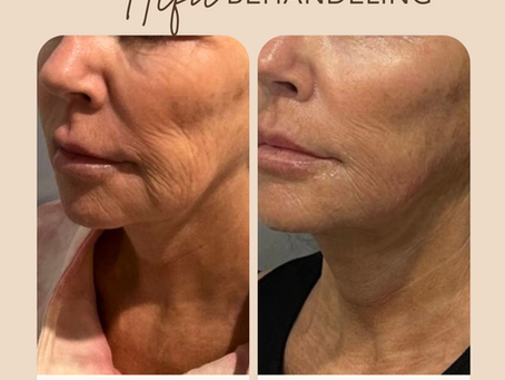 Waarom steeds meer vrouwen in België kiezen voor onze HIFU Behandeling