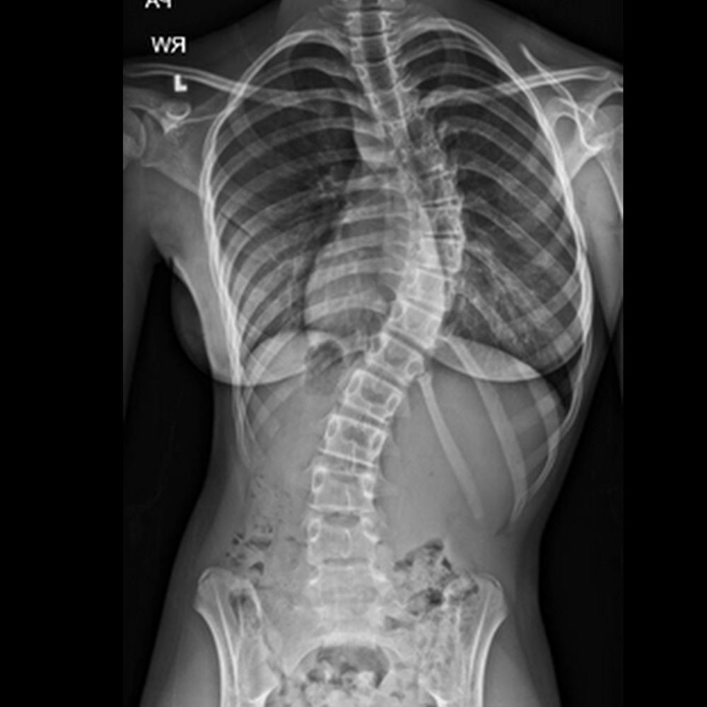 Scoliosis... the sideways spinal curve that could be causing your uneven shoulders and hips!