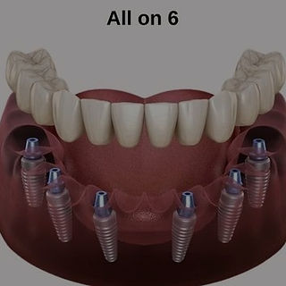 all-on-six- istanbul