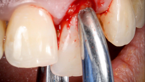 ¿Qué es la extracción dental?