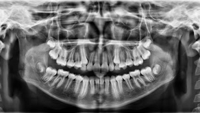 ¿Qué es una radiografía panorámica y cuál es su uso en odontología?