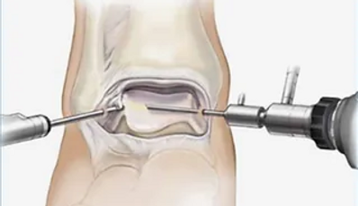 Ankle Arthroscopy.png