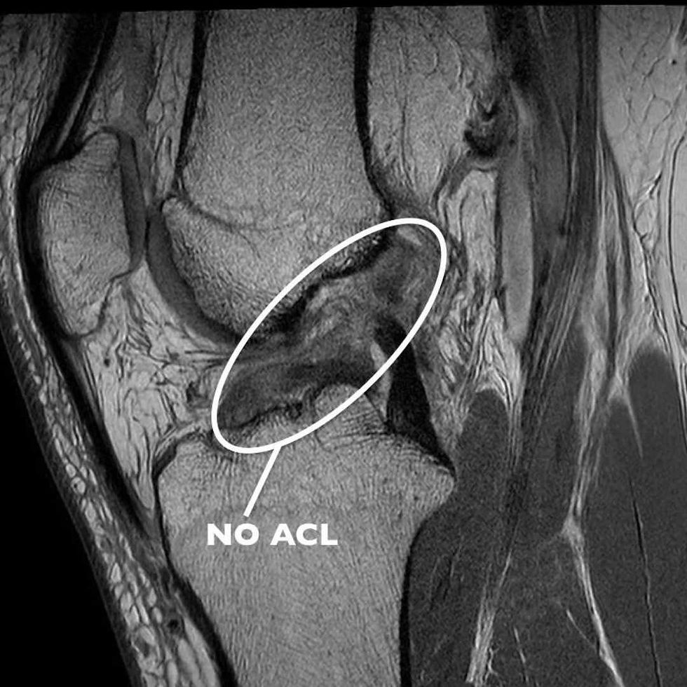 ACL injury