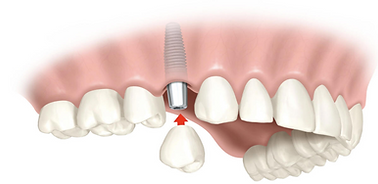 servicio-implantes-dentales-2-e149000434