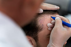 adult-male-doing-follicular-unit-extraction.jpg