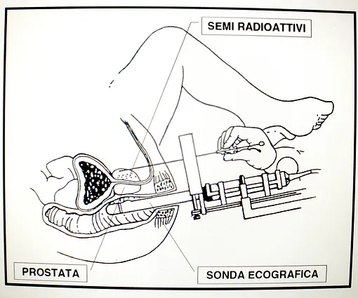 tumore prostata aghi radioattiviti