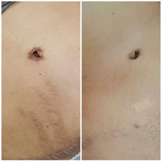 Tratamiento Biocober para camuflar estrías tras el embarazo antes y después