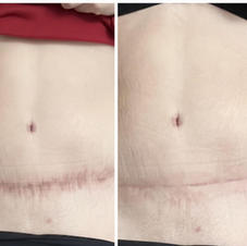 Regeneración de cicatriz quirúrgica en abdomen técnica DMP Medical
