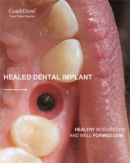 img-healed-dental-implant.jpg