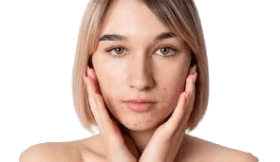 Trattamento dell'acne con Retinolo