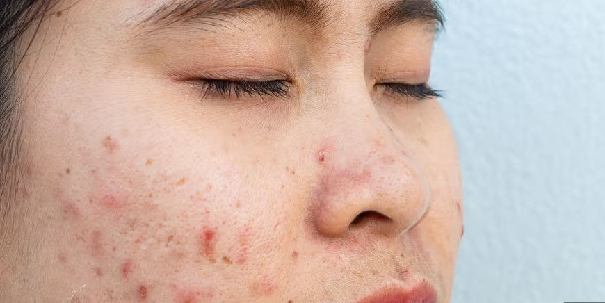 Acne Viso cos'e e come curare
