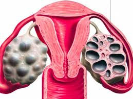 Sindrome dell'ovaio policistico: il microbiota intestinale