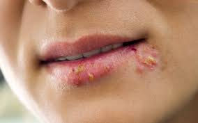 Herpes simplex del labbro cos'è e come si cura