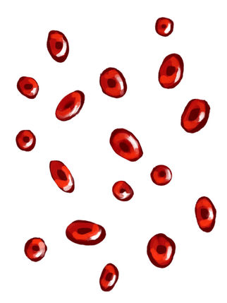 Chronic Fatigue as a Symptom: Recognizing Iron Deficiency Anemia in Women