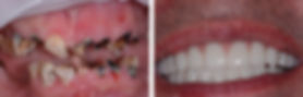 Mike before and after dental implants