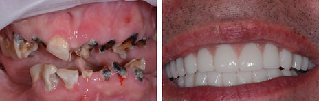 Mike before and after dental implants