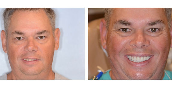 Mark before and after dental implants