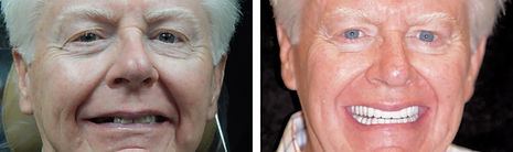 James before and after dental implants