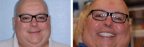Mike proudly smiling after his dental implant surgery