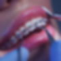 pngtree-close-up-of-orthodontic-braces-application-with-blue-lighting-and-professional-ima