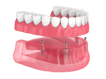 A picture of All-On-Four Implants treatment