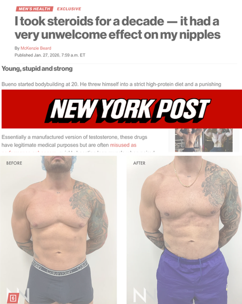 Before-and-after gynecomastia surgery illustrating the effects of long-term anabolic steroid use and male breast reduction treatment.