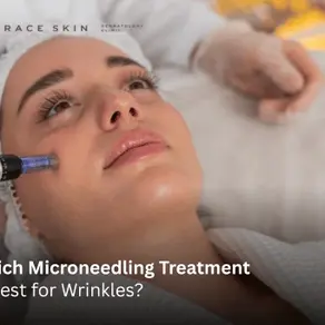 Which Microneedling Treatment Is Best for Wrinkles?