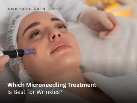 Which Microneedling Treatment Is Best for Wrinkles?