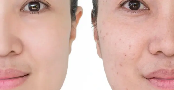 Microneedling Treatment