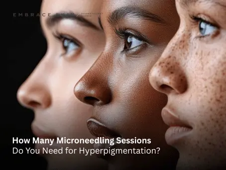 Microneedling Sessions
