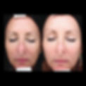 Halo Laser Treatment Before and After