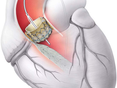 TAVI (Transcatheter Aortic Valve Implantation