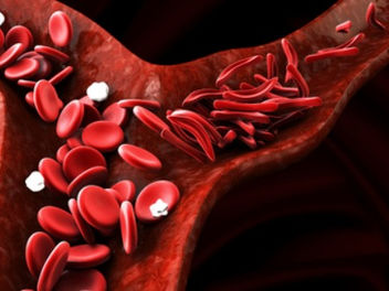 ANEMIA FALCIFORME