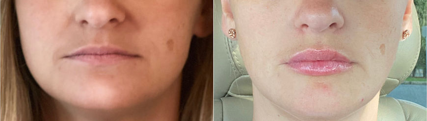 Lip Filler from Blah to Bam.jpg