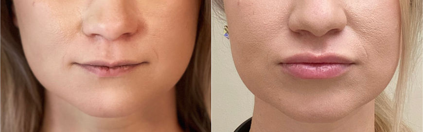 Lip FIller from Ehh to Ohhh in One Syringe.jpg