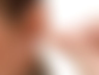 CHẤN THƯƠNG TAI---> thủng màng nhĩ ( trưc tiếp hay gián tiếp ).